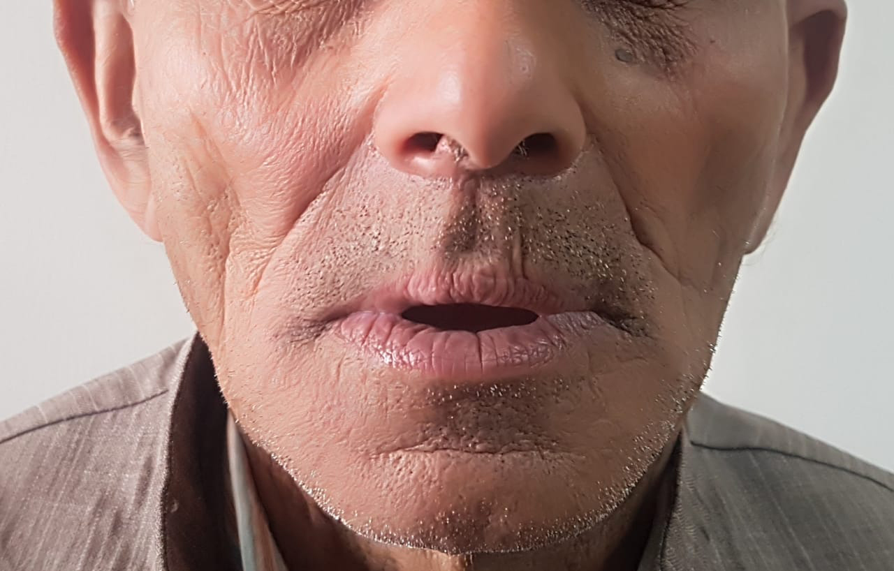 Patient without upper and lower teeth