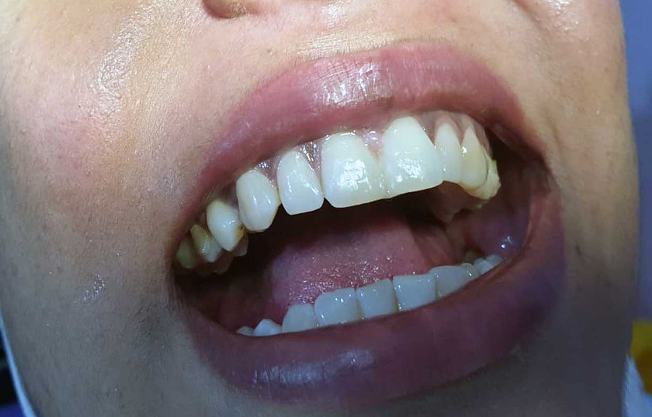 Veneers and composite resin filling