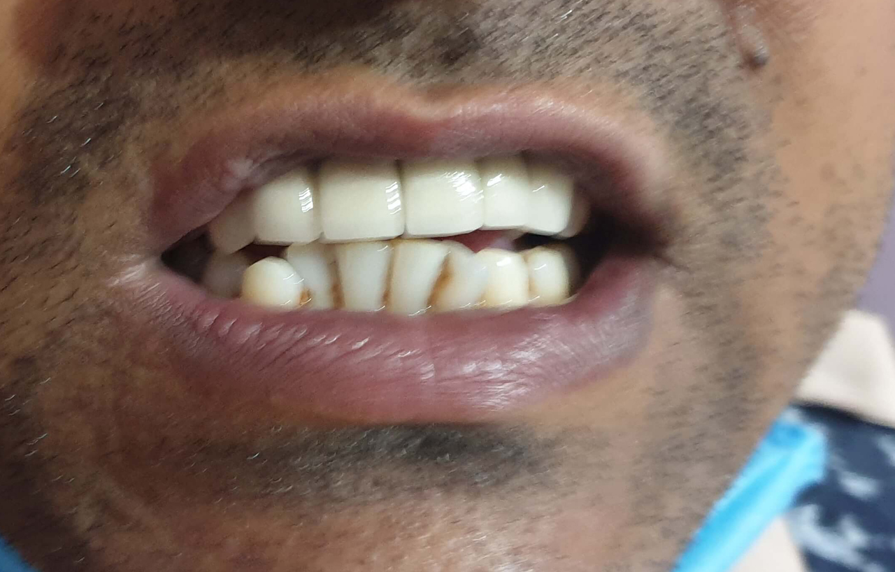 Fabrication of crown and bridge (FPD) in patient